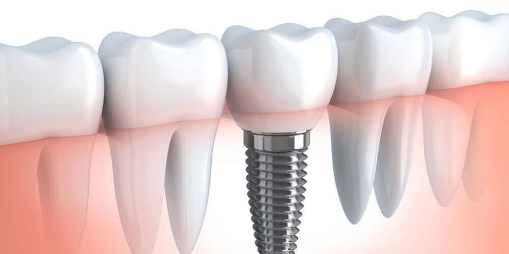 Dental Implants Woodstock